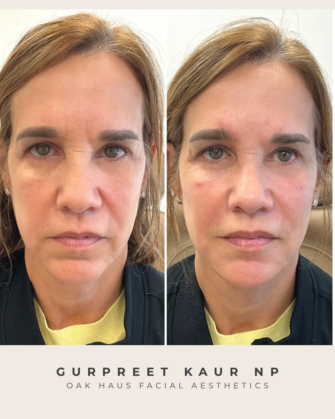 Before and after - Gurpreet Kaur NP, Oak Haus Facial Aesthetics