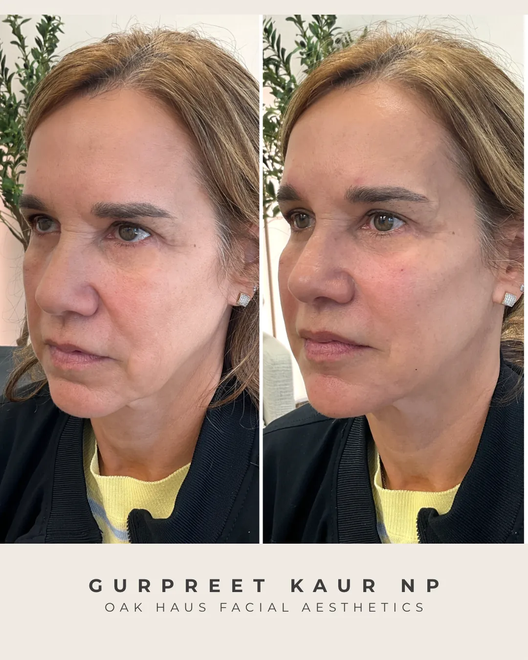 Before and after - Gurpreet Kaur NP, Oak Haus Facial Aesthetics