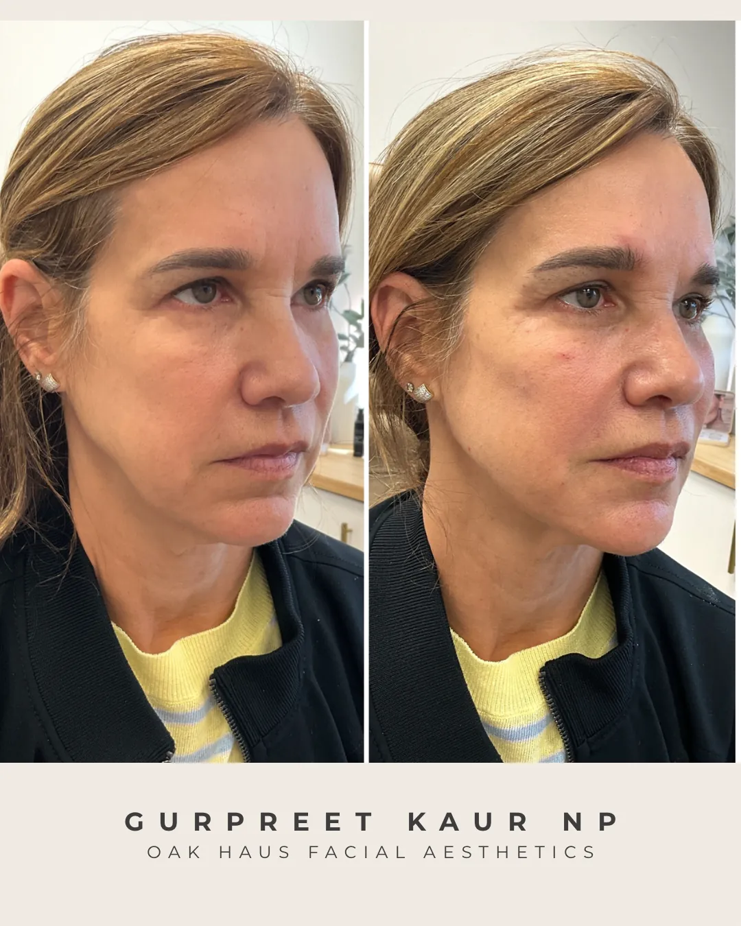 Before and after - Gurpreet Kaur NP, Oak Haus Facial Aesthetics