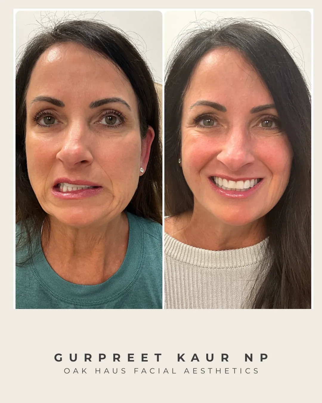 Before and after - Gurpreet Kaur NP, Oak Haus Facial Aesthetics