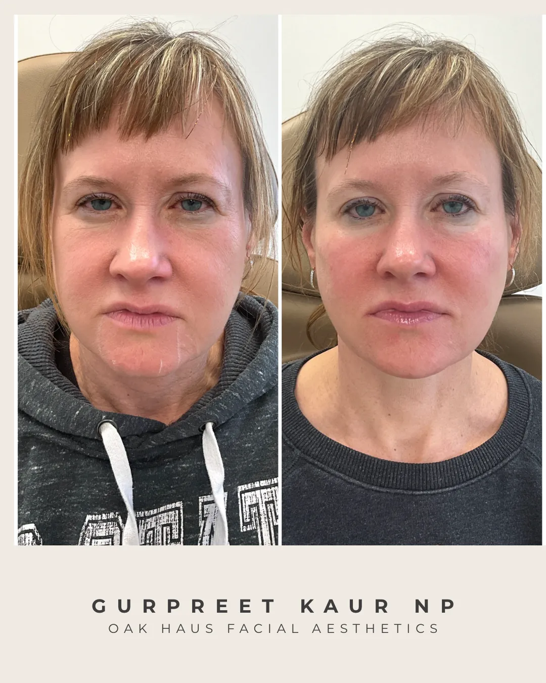 Before and after - Gurpreet Kaur NP, Oak Haus Facial Aesthetics