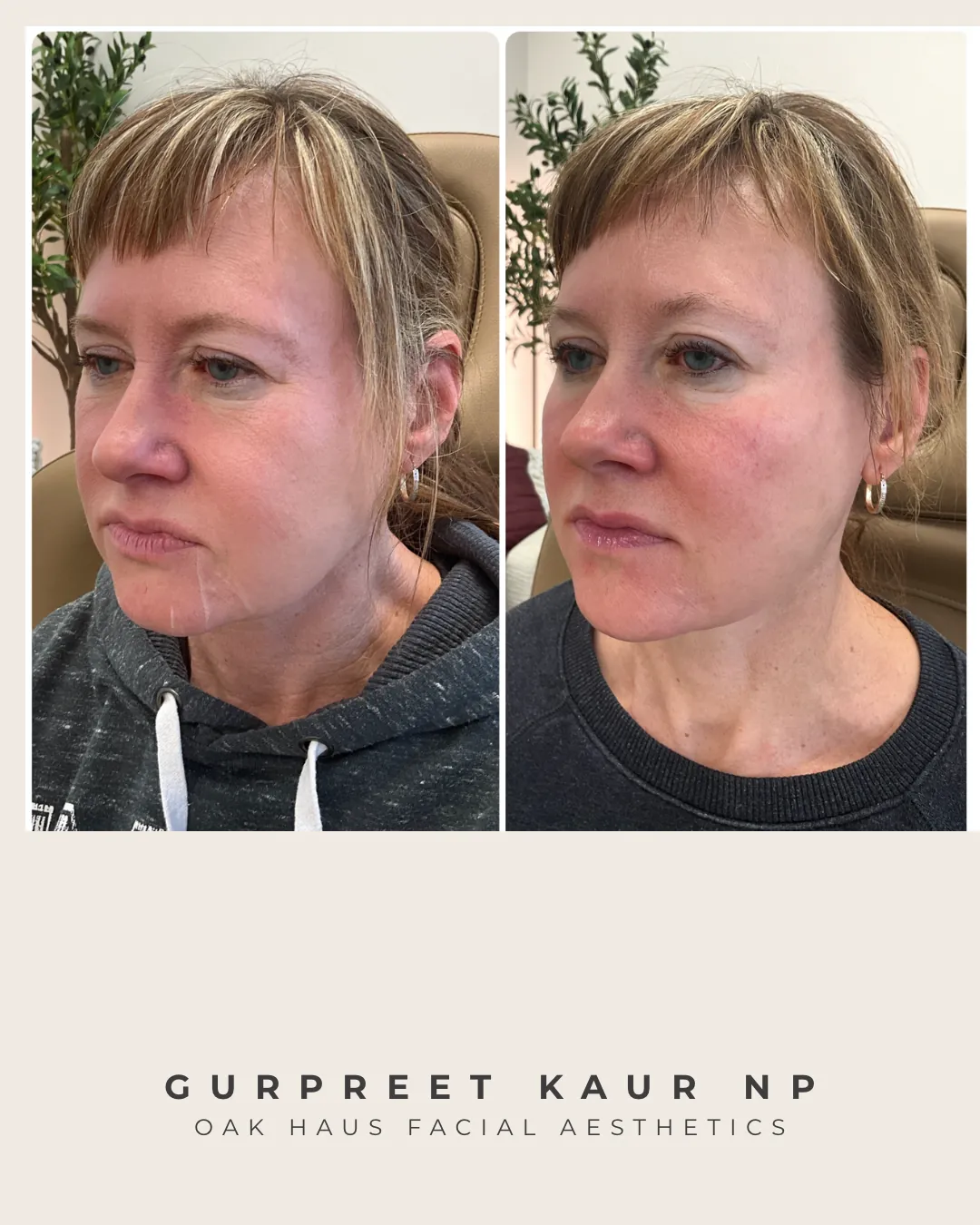 Before and after - Gurpreet Kaur NP, Oak Haus Facial Aesthetics