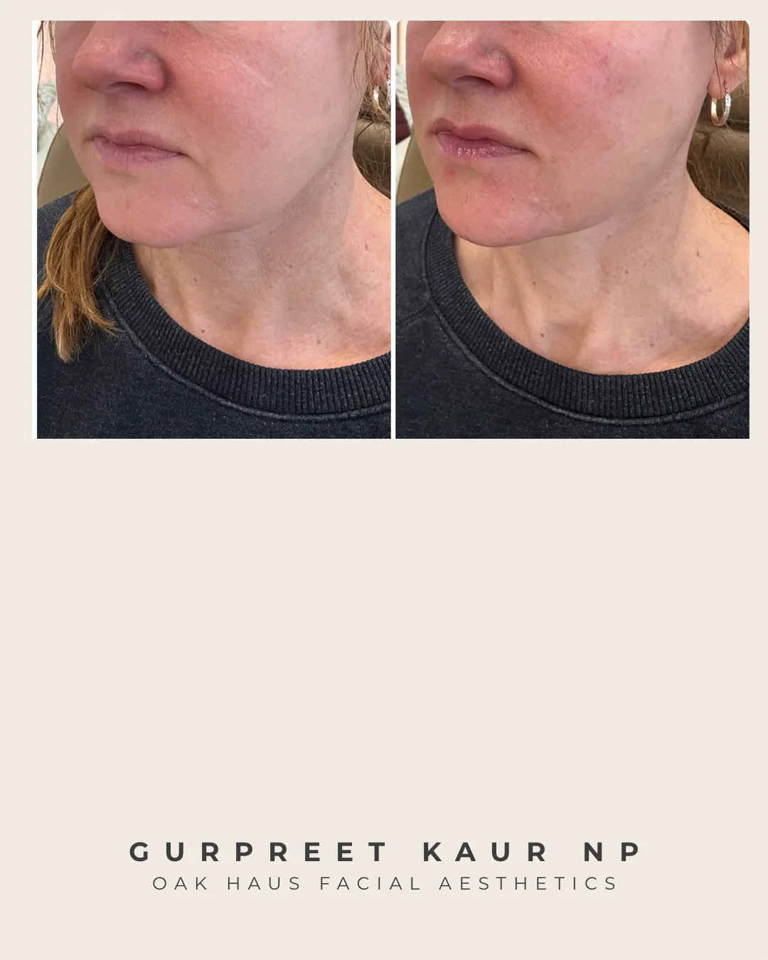 Before and after - Gurpreet Kaur NP, Oak Haus Facial Aesthetics