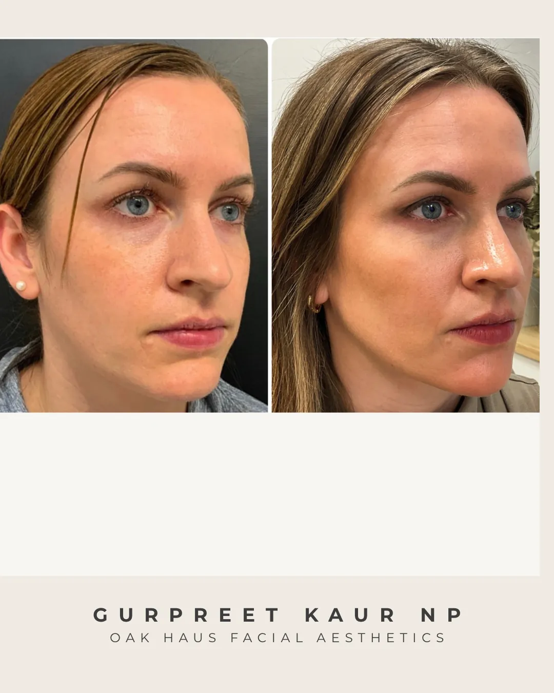 Before and after - Gurpreet Kaur NP, Oak Haus Facial Aesthetics