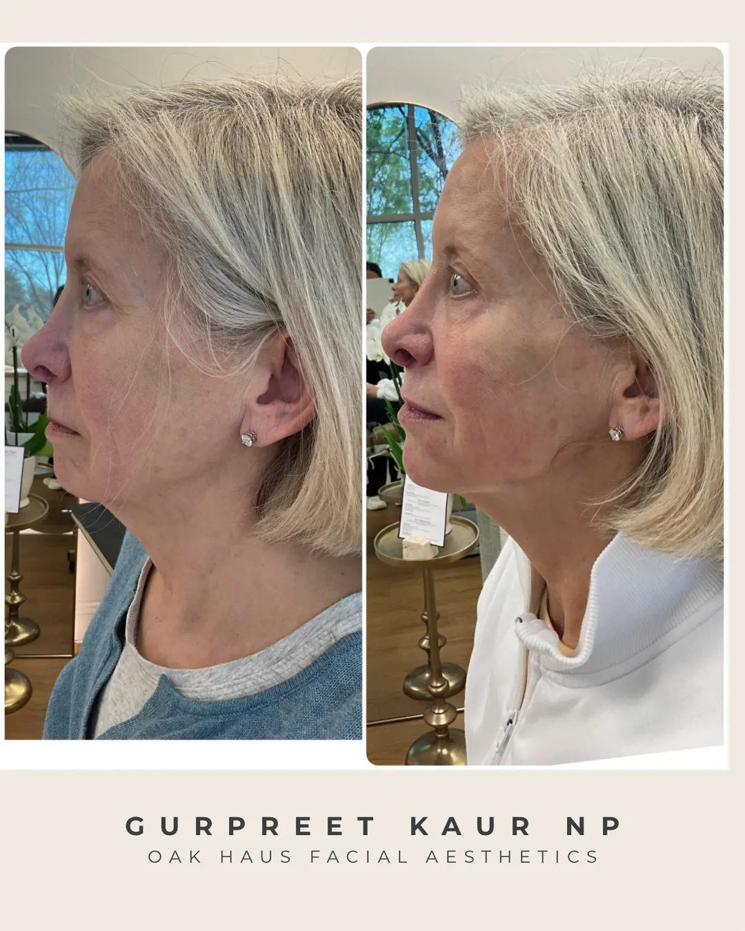 Before and after - Gurpreet Kaur NP, Oak Haus Facial Aesthetics