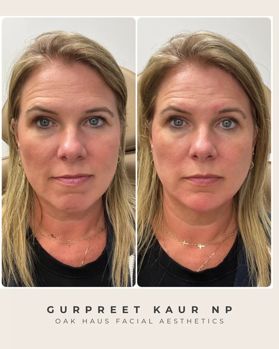 Before and after - Gurpreet Kaur NP, Oak Haus Facial Aesthetics