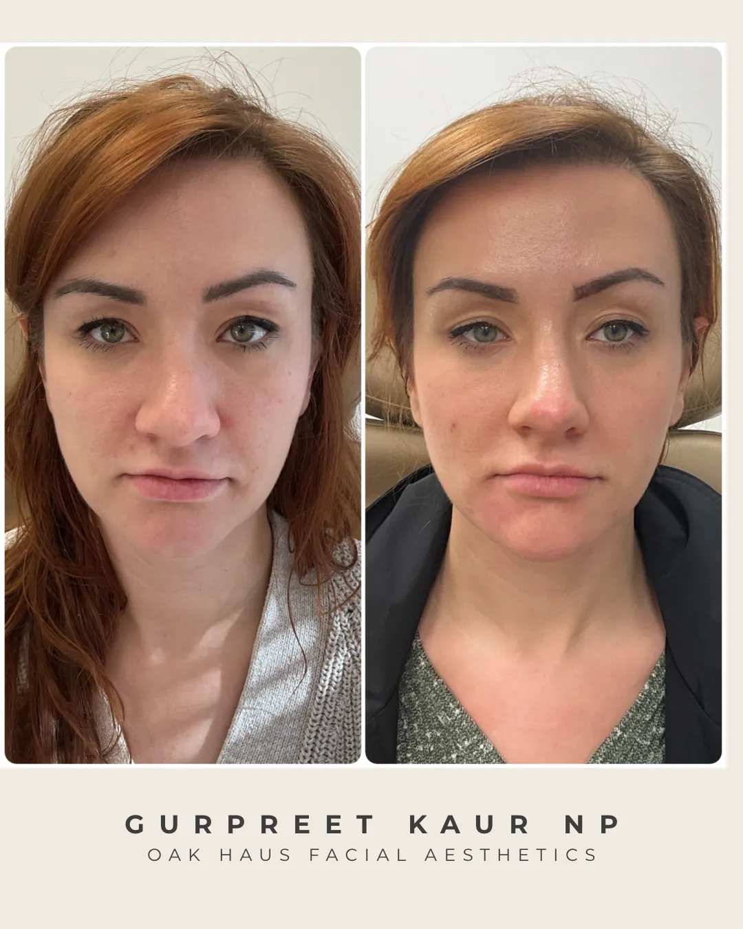 Before and after - Gurpreet Kaur NP, Oak Haus Facial Aesthetics
