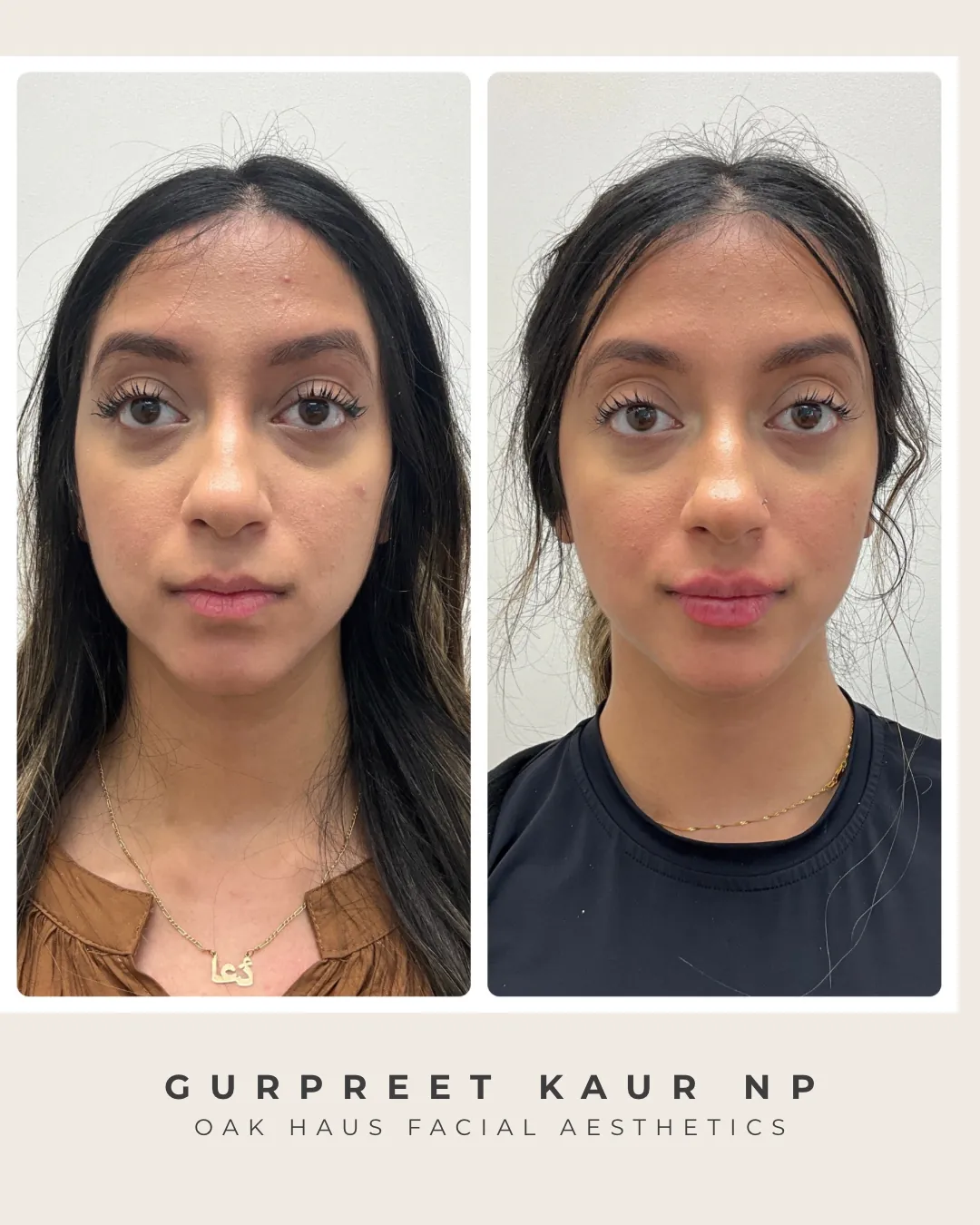 Before and after - Gurpreet Kaur NP, Oak Haus Facial Aesthetics