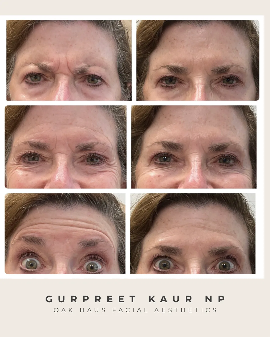 Before and after - Gurpreet Kaur NP, Oak Haus Facial Aesthetics