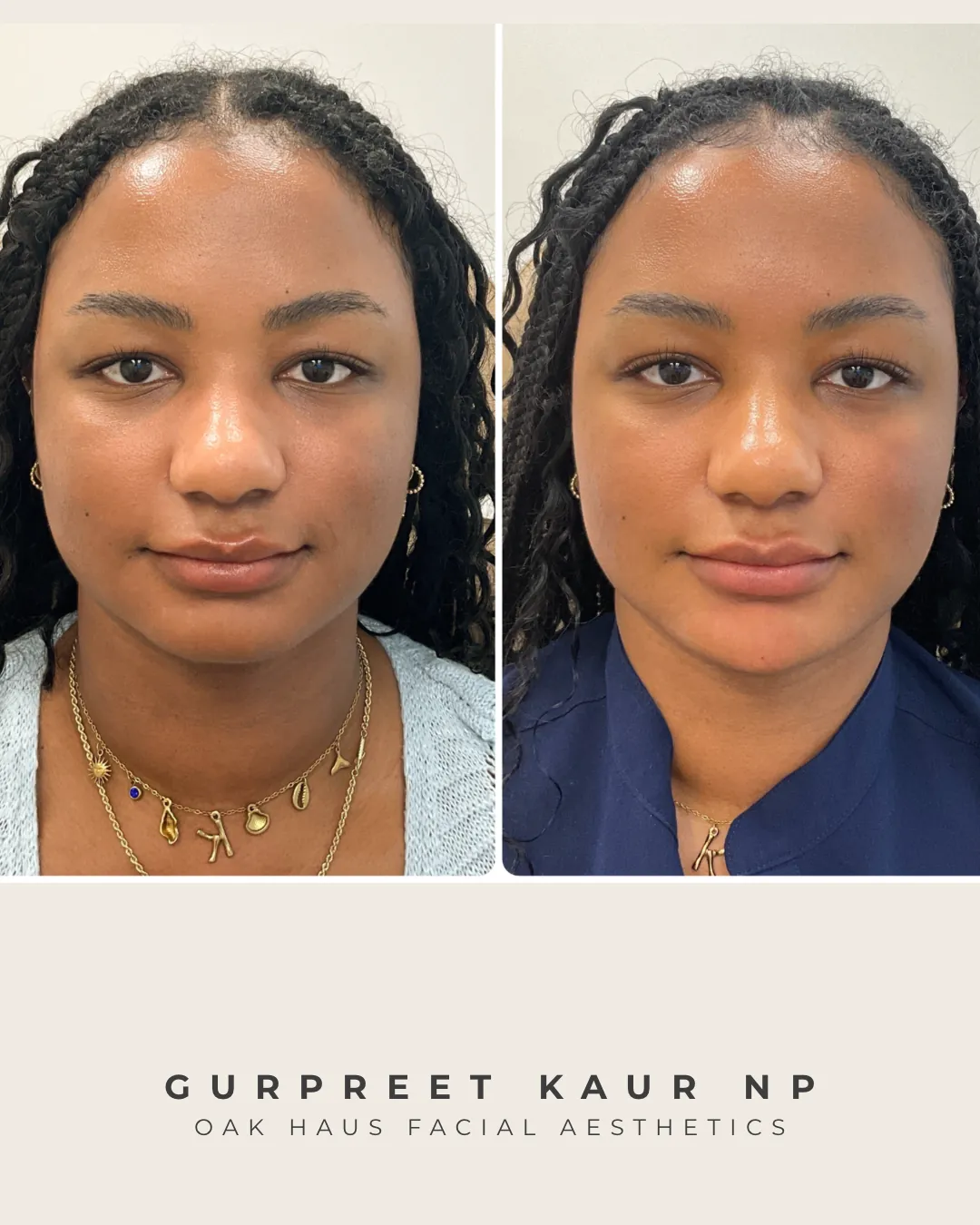 Before and after - Gurpreet Kaur NP, Oak Haus Facial Aesthetics