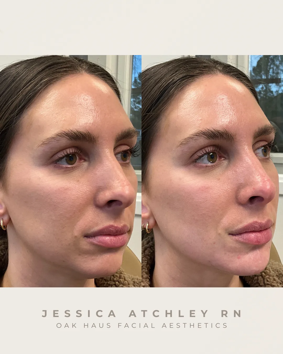 Before and after - Jessica Atchley RN, Oak Haus Facial Aesthetics