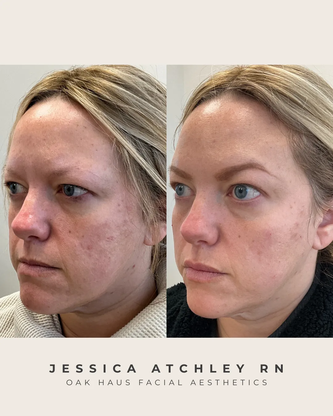 Before and after - Jessica Atchley RN, Oak Haus Facial Aesthetics