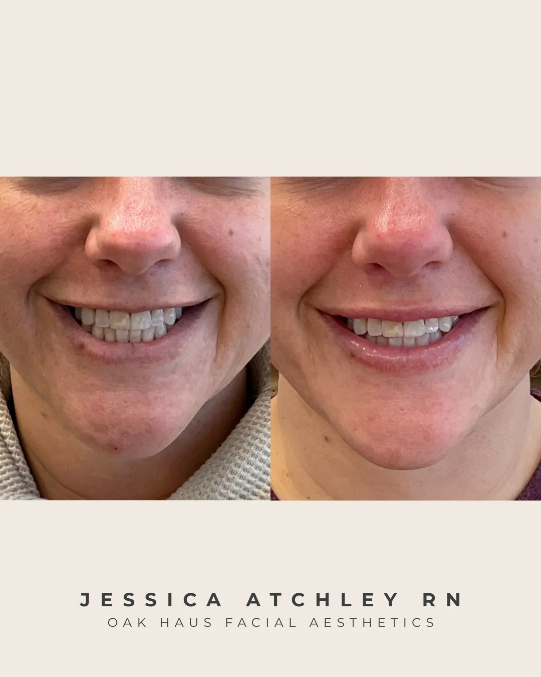 Before and after - Jessica Atchley RN, Oak Haus Facial Aesthetics